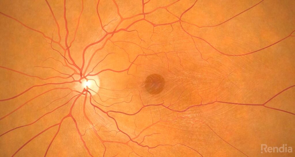 Macular Holes Treatment to Restore Central Vision Clarity